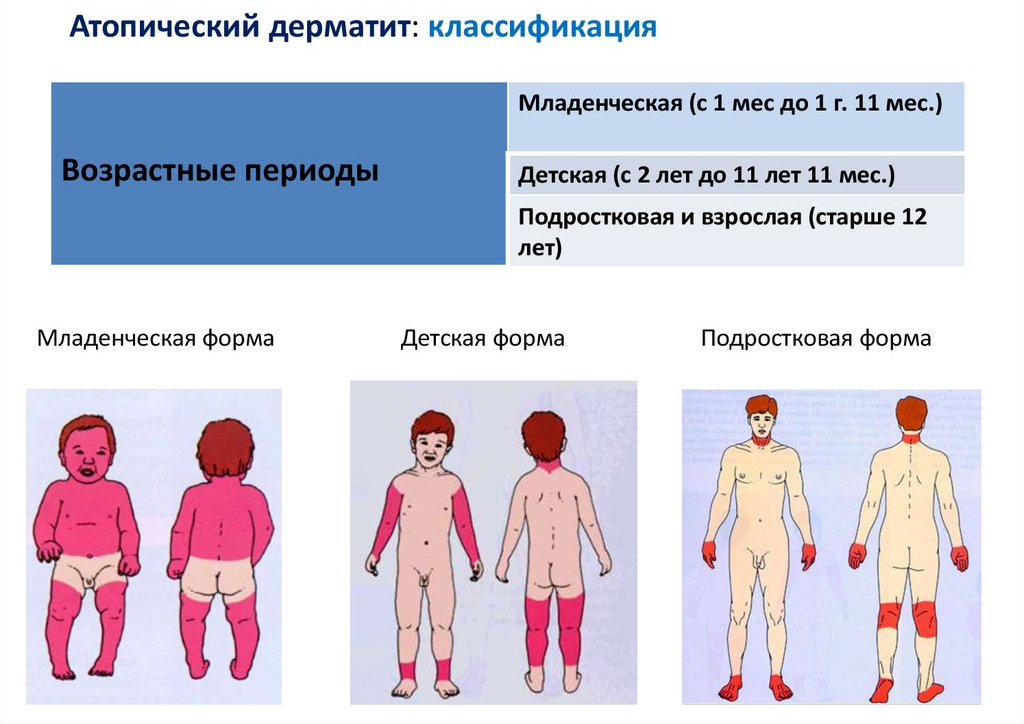 Возрастные стадии атопического дерматита. Атопический дерматит формы по возрасту. Диффузный нейродермит (в т.ч. атопический дерматит);. Атопический дерматит локализация у детей.