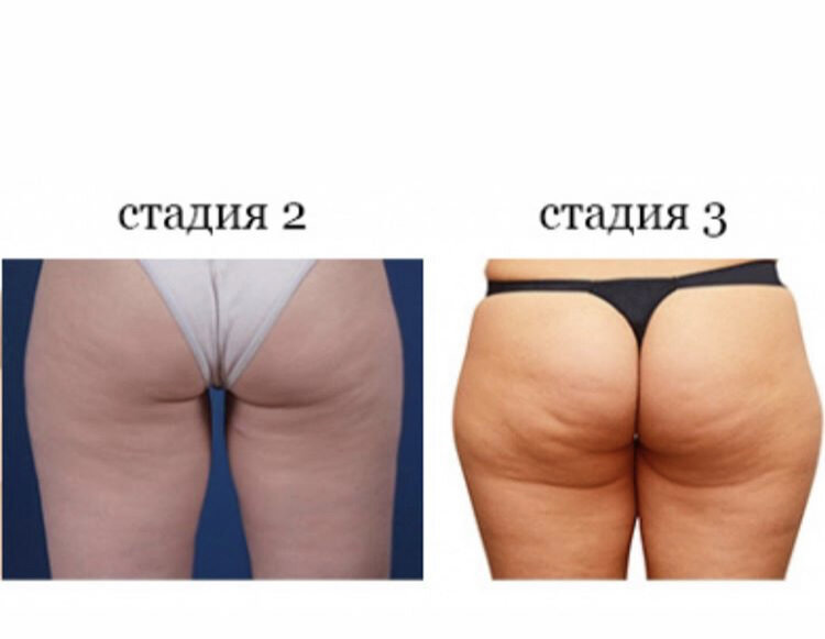  Крупная попа с 2-3 степенью целлюлита