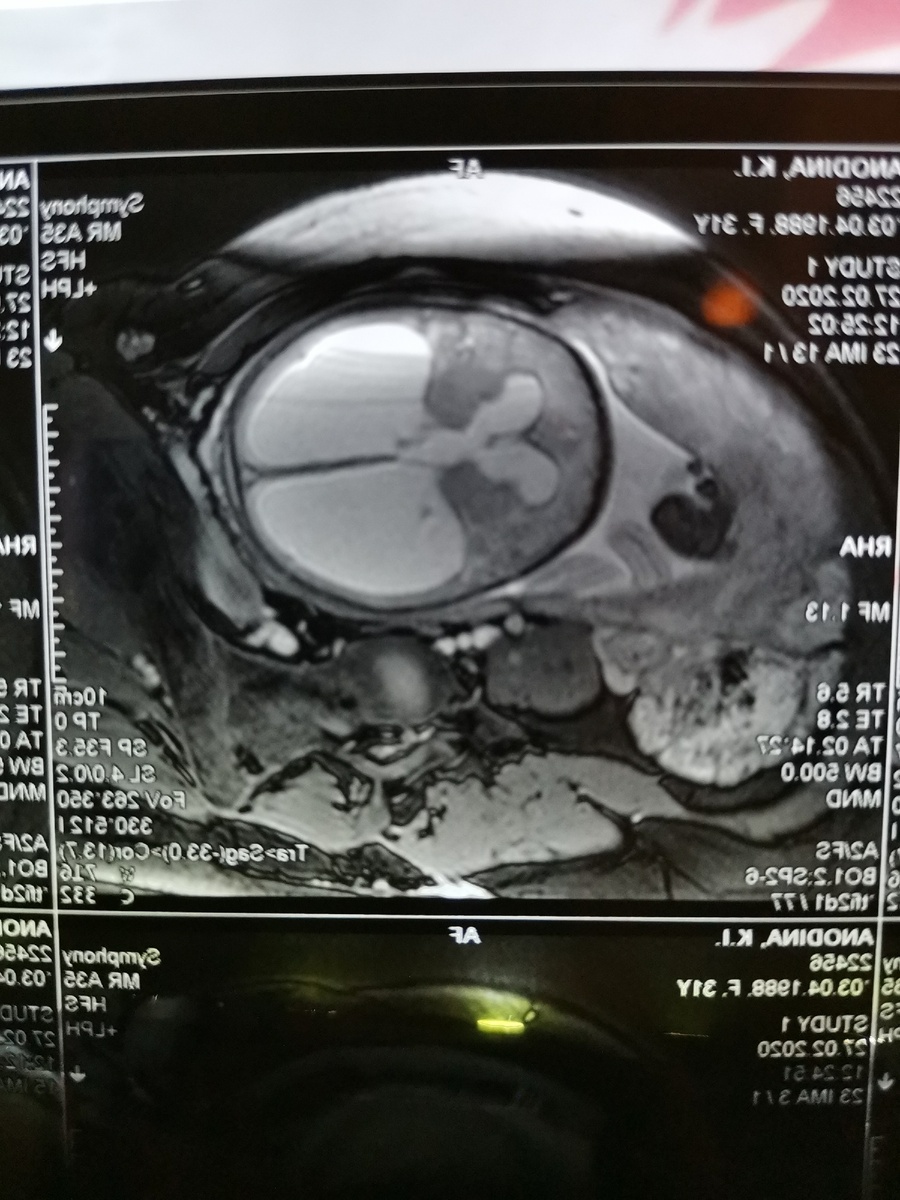 Там где белое в голове, это не мозг, это все ликвор.....