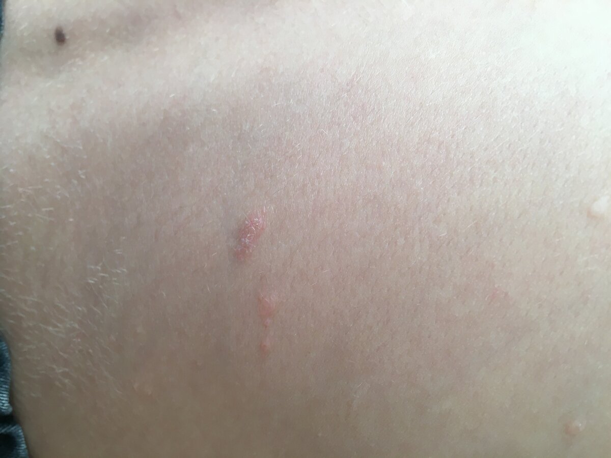 Розовый лишай Жибера (pityriasis rosea, питириаз розовый, болезнь Жибера, розеола шелушащаяся)
