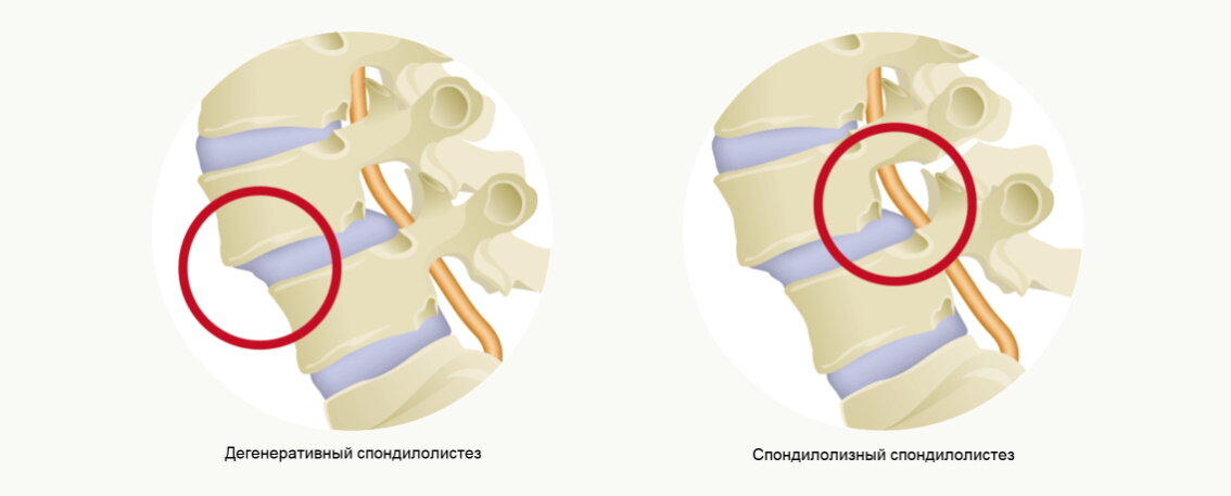 Спондилолистез, или смещение позвонков