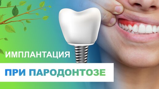 ✔️ Имплантация зубов при пародонтозе