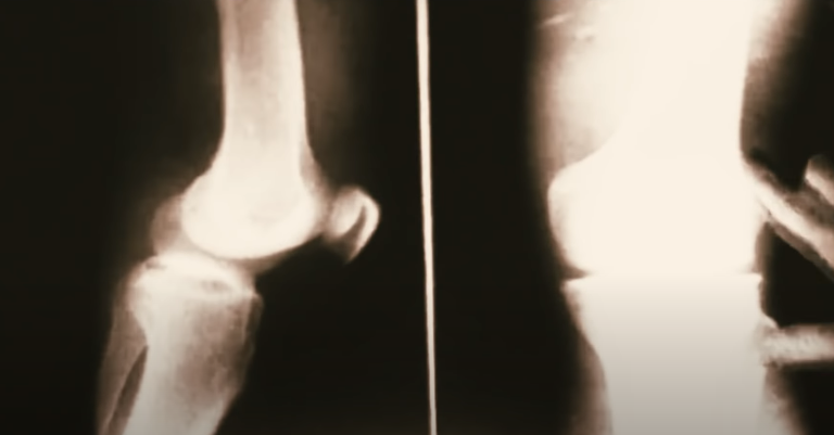 Снимок ноги со смещением таза