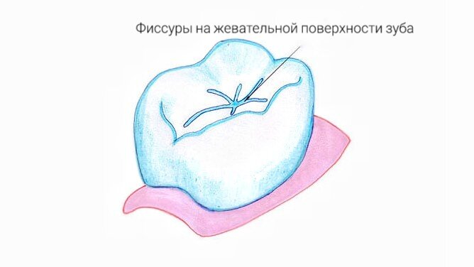 Фиссуры, которые мы видим на поверхности зуба