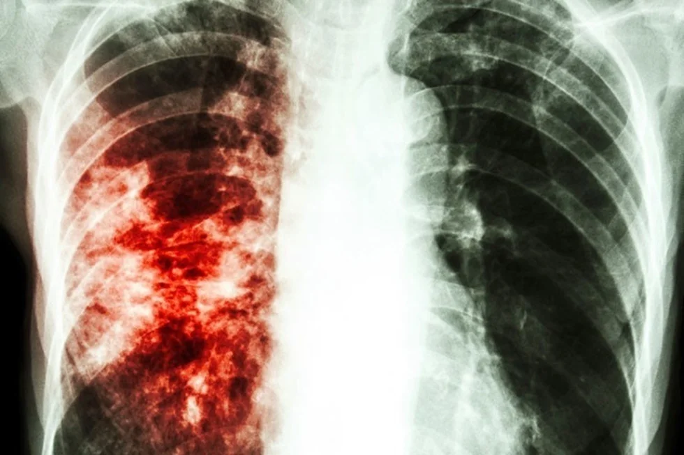 Туберкулез tuberculosis. Туперкцлёс.