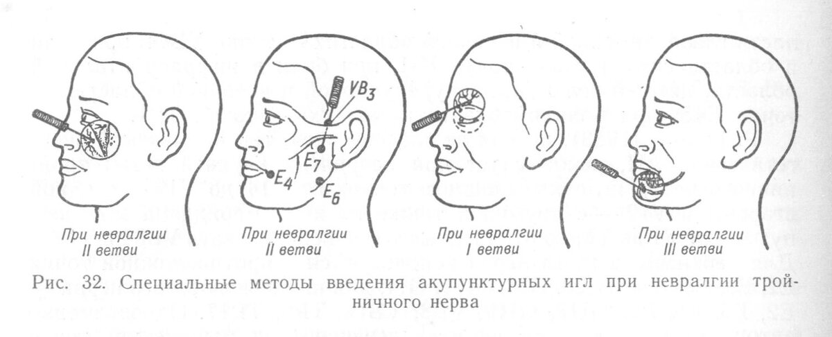 Невралгия тройничного нерва