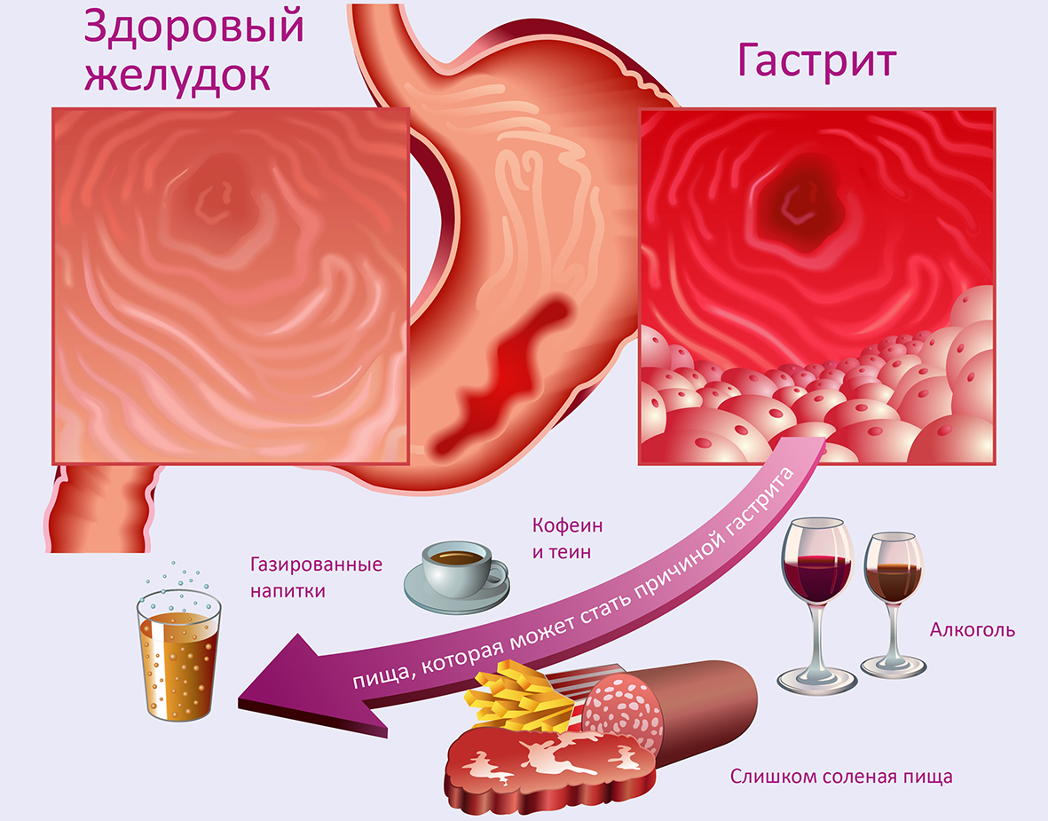 Профилактика ябж картинки