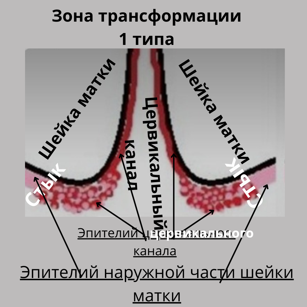 Дисплазия многослойного эпителия. Зона трансформации шейки 1 типа. Зона трансформации 3 шейки матки. Зона трансформации зт 3 тип. Зона трансформации 3 типа.