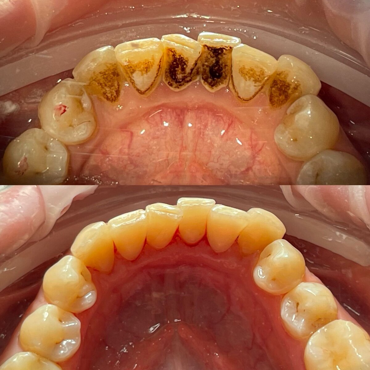Ультразвуковая чистка