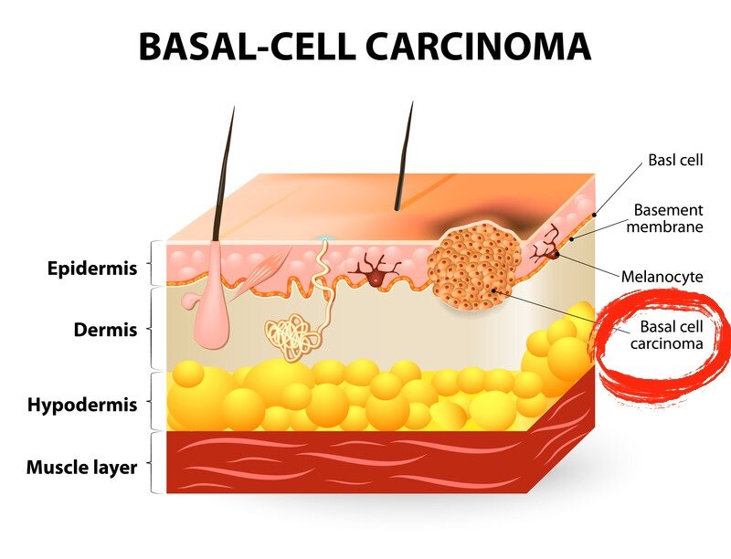Basal cell carcinoma — базально-клеточный рак