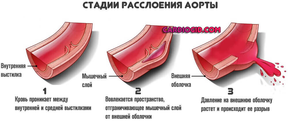 Расслаивающаяся аневризма аорты презентация