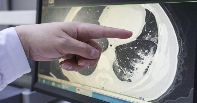 Снимок КТ легких пациента с Covid-19, Источник: www.statnews.com