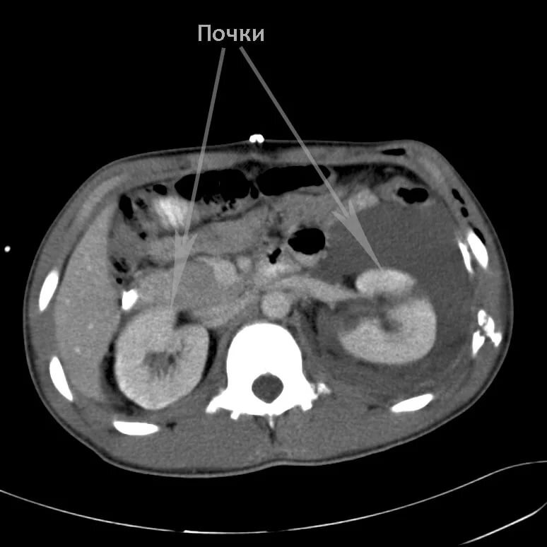 Мскт почек. Кт почек с контрастированием кт. Кт почек с контрастированием норма. Кт почек Натив что это.