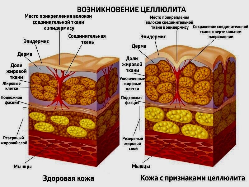 Что такое целлюлит у женщин простыми словами. Целлюлит в разрезе. Стадии целлюлита в картинках.