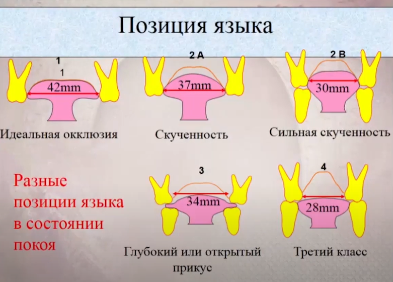 Правильное положение языка во рту мьюинг картинки