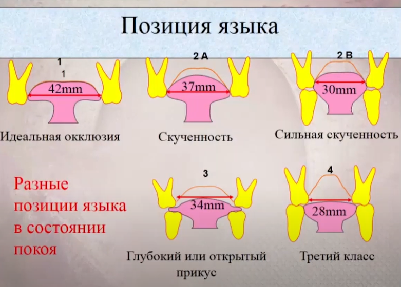 Язык во рту в спокойном состоянии. Правильное положение языка. Неправильное положение языка. Мюинг положение языка схема.