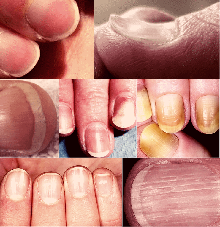 Ногти часто кричат о вашем здоровье, важно уметь слушать.