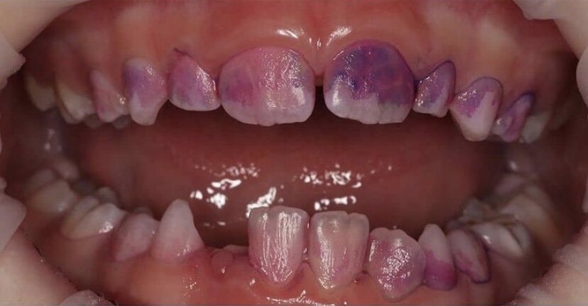 Зубы, окрашенные индикатором налёта.