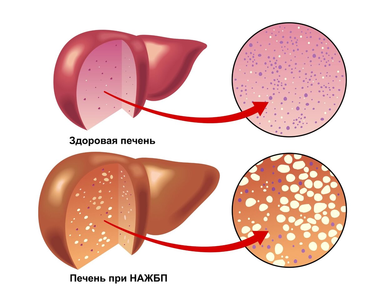 Болезнь печени жировой гепатоз