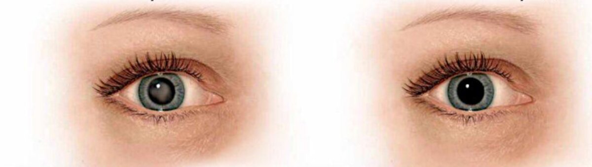 Меняется и цвет зрачка