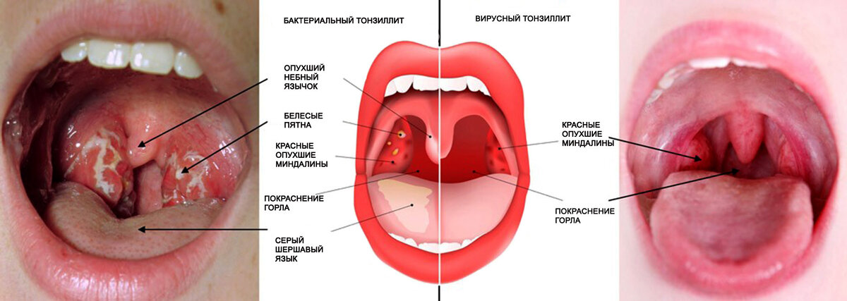 Болезни горла, хронические заболевания горла - диагностика и лечение в Москве