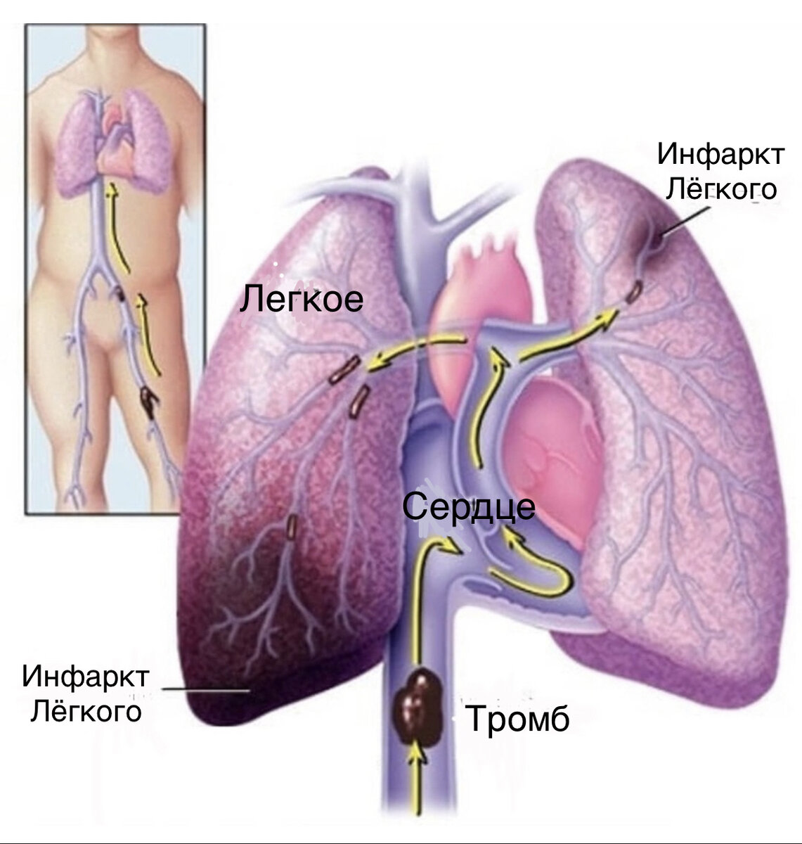 Легочная эмболия что. Тромбоэмболия легочной артерии. Эмболия легочной артерии. Легочная тромбоэмболия симптомы.