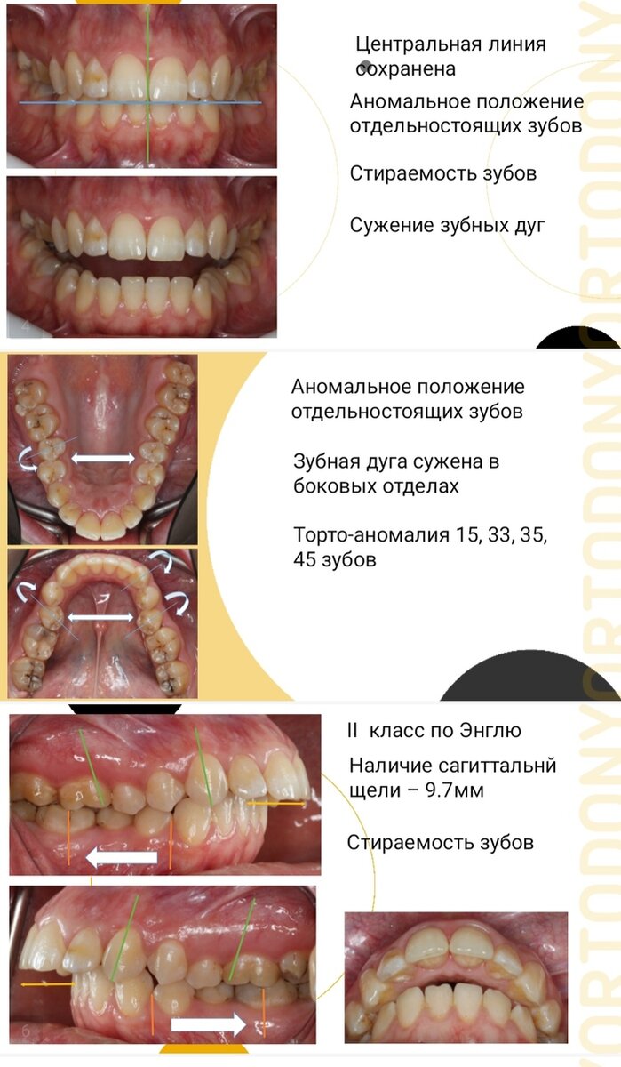 Классификации аномалий положения зубов в ортодонтии