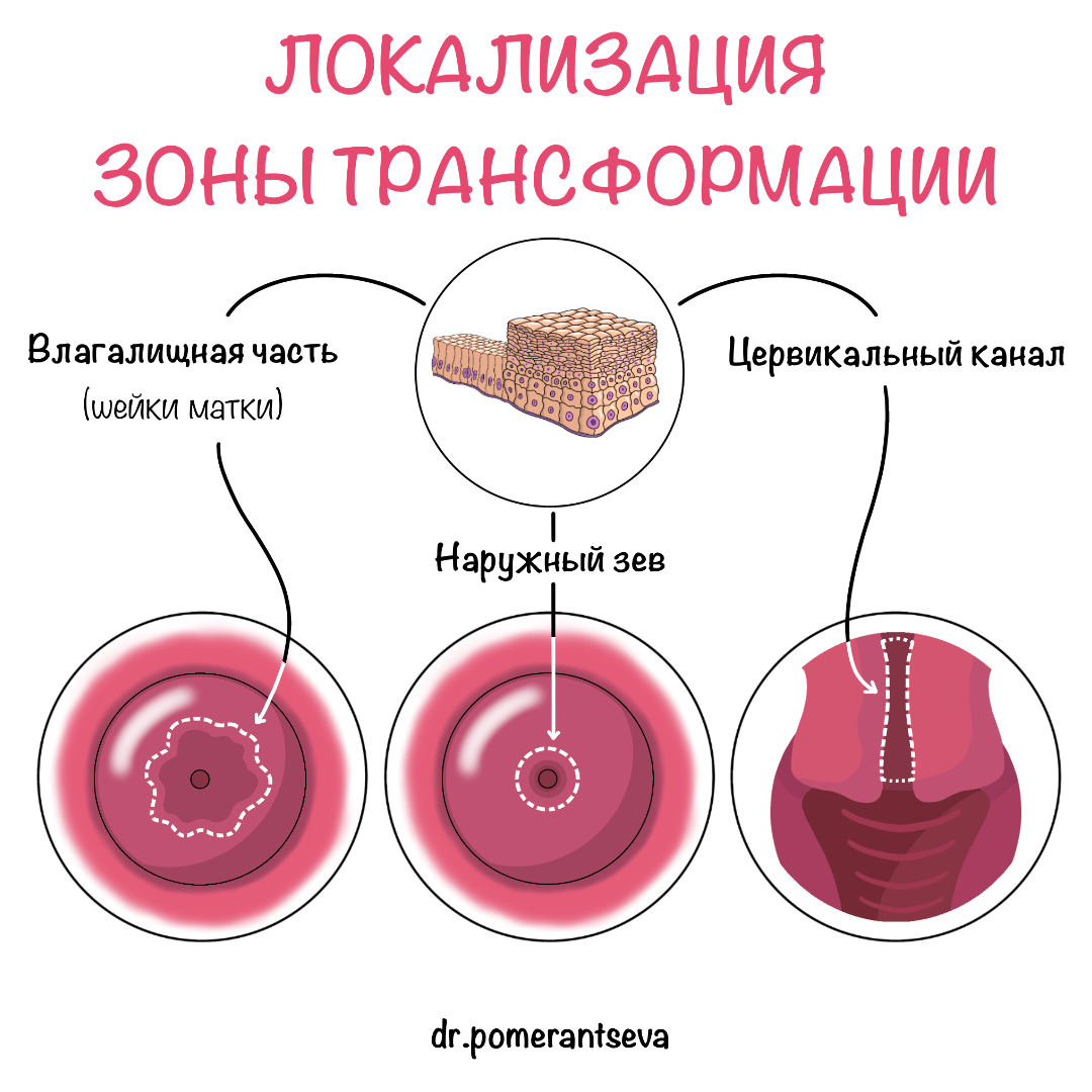 Клетки зоны трансформации обнаружены. Зона трансформации 1 типа. Доброкачественная зона трансформации что это. Зона трансформации шейки 3 Тип.