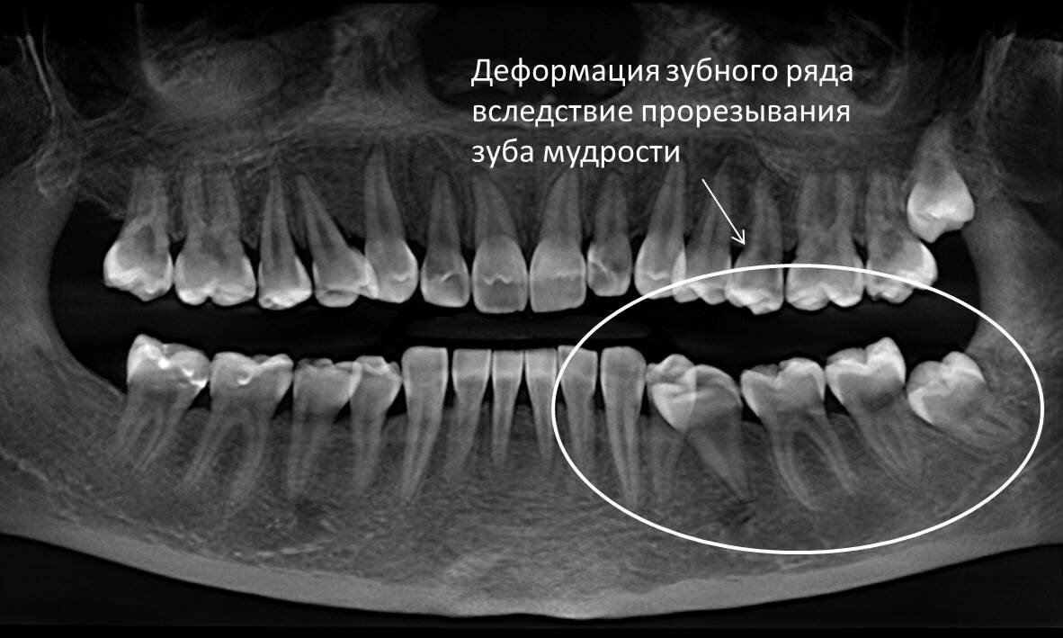 Зуб утрачен. Как скрыть отсутствие?