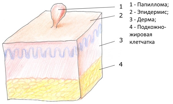 Папиллома выглядит, как горошинка на ножке. У белокожих людей выросты светлые, у смуглых - слегка пигментированные.