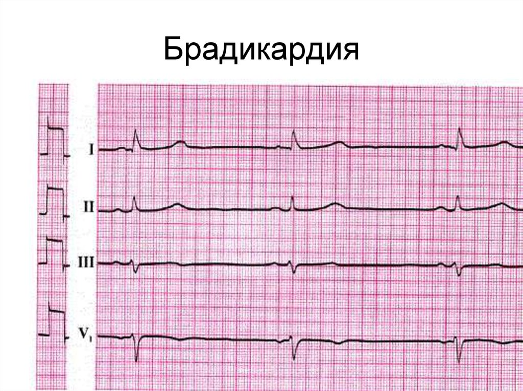 Что показывает кардиограмма сердца