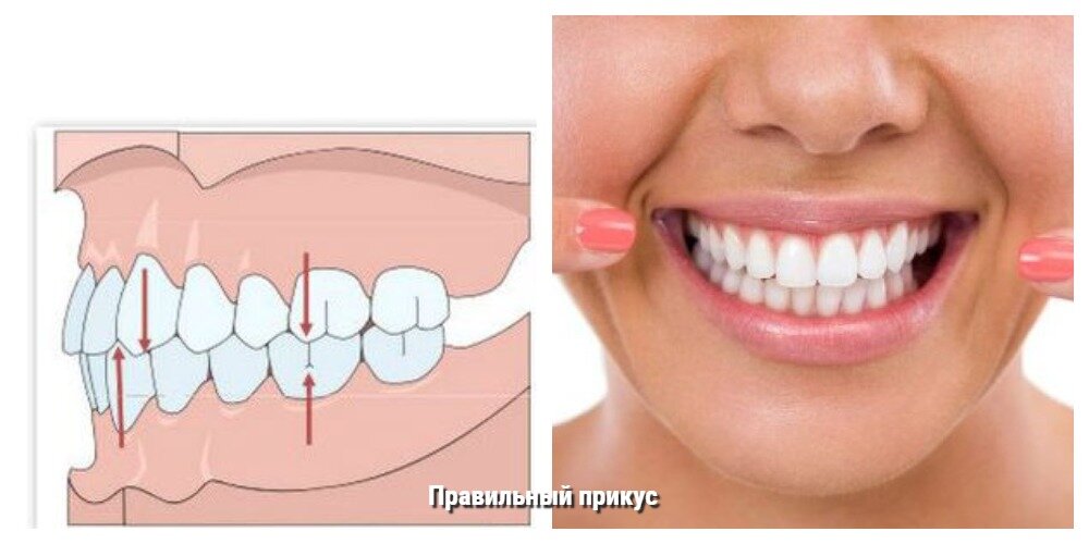 Правильный прикус сбоку и спереди 