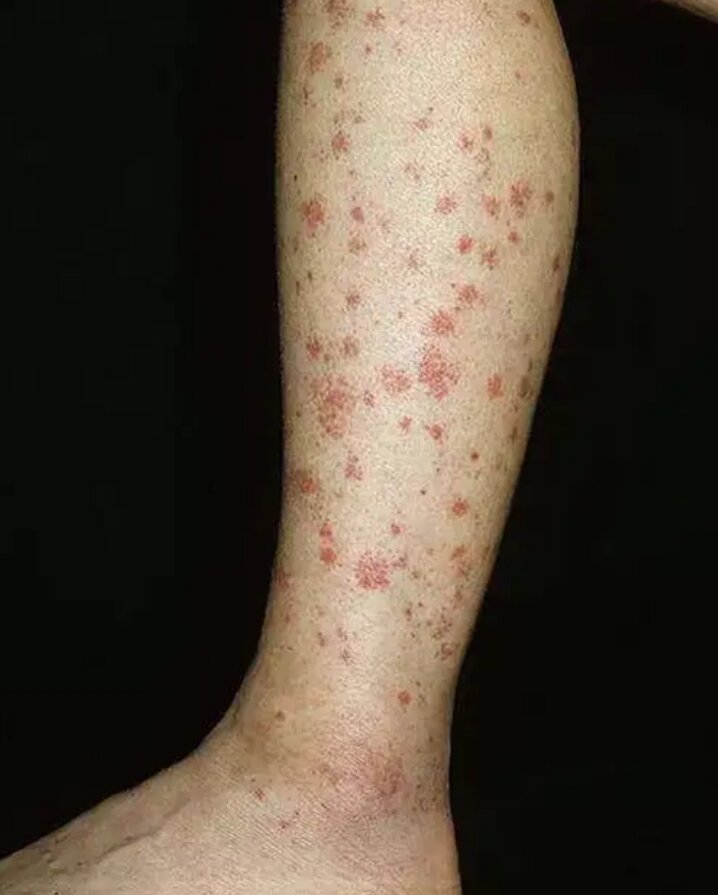 так выглядит васкулит  (фото взято из свободного доступа)