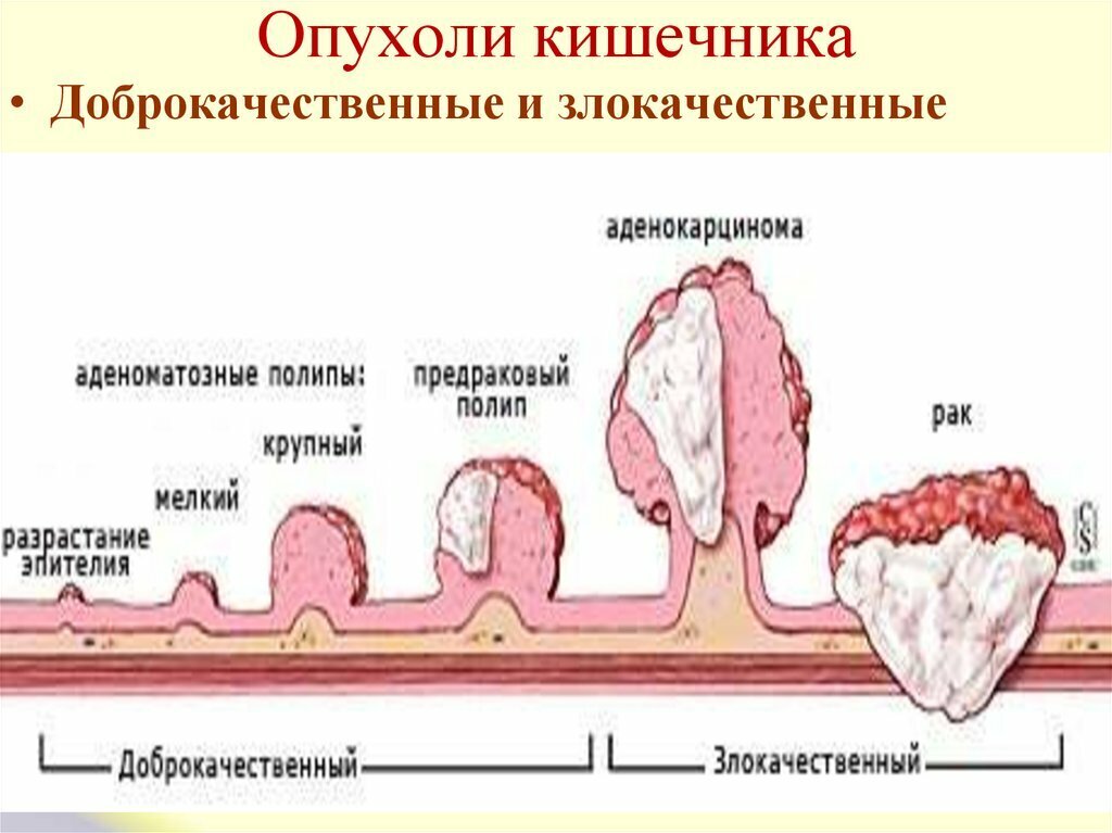 Степени рака сигмовидной кишки