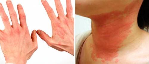 
Аллергическая крапивница может поражать большие площади тела