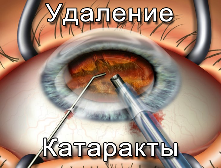 Операция по удалению катаракты