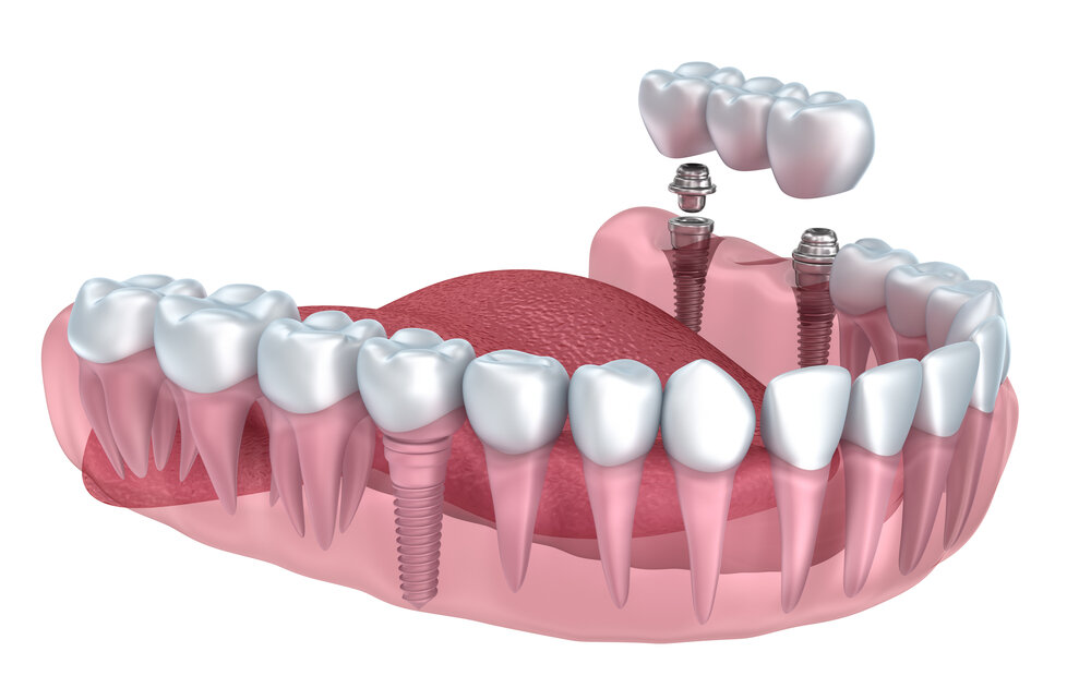 Протезирование зубов в казани. Мостовидный протез 3 ед МК что это. Мостовидные протезы ортопедическая стоматология. Несъемный мостовидный протез. Мостовидный протез это ортопедия.