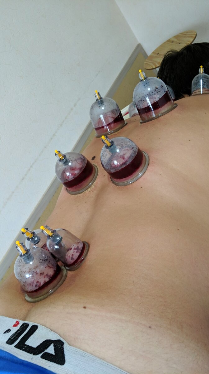 АРТЕРИАЛЬНАЯ ГИПЕРТЕНЗИЯ 
 
Артериальная гипертензия - повышение давления в сосудах крови, в результате чего наносится серьёзный вред организму. 
 
Риски: 
кровоизлияния как следствие разрыва сосудов (инсульт); 
ишемия - прекращение притока крови к тканям (инфаркт). В обоих случаях происходит нехватка крови в тканях, в результате чего они погибают полностью или частично. 
 
За счет чего повышается давление в сосудах? 
В организме содержатся мелкие, средние и крупные сосуды крови. 
В норме кровь движется по всем этим сосудам под оптимальным давлением для них. 
 
При артериальной гипертензии происходит спазм или закупорка мелких сосудов, впоследствии тот же объем крови движется теперь только по средним и крупным сосудам. 
Это и увеличивает давление в этих сосудах. 
Почему происходит спазм, закупорка и разрыв сосудов? 
Спазм - сокращение сосудов, как следствие повышения концентрации в крови веществ-регуляторов сосудо-сократителей, и понижения - сосудо-расширителей. 
 
Закупорка сосудов - осложнение в виде бляшек и других изменений внутренней стенки сосудов, из-за продолжительного присутствия в крови вредных "отходов". Разрыв сосудов - как осложнение тонких и ломких сосудов. 
Причина - избыток вредных "отходов" и нехватка полезных веществ (вит.С,Р и др.) в крови. 
Тактика лечения: 
снизить давление в сосудах; 
снизить в крови уровень концентрации веществ - регуляторов сосудо-сократителей и вредных "отходов"; 
восполнить в крови нехватку веществ - регуляторов сосудо-расширителей и других необходимых веществ; 
поддерживать баланс работы сосудов. 
Как хиджама помогает при артериальной гипертензии? 
Выводит из крови избыток вредных веществ. 
Восполняет кровь необходимыми веществами за счет стимуляции собственных ресурсов. 