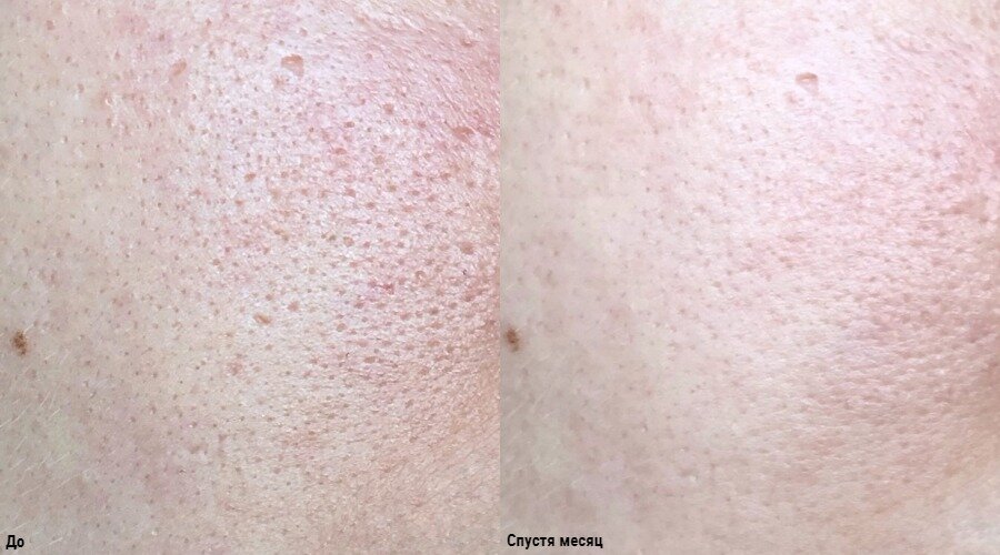 Показываю фото, как изменилась моя кожа за месяц