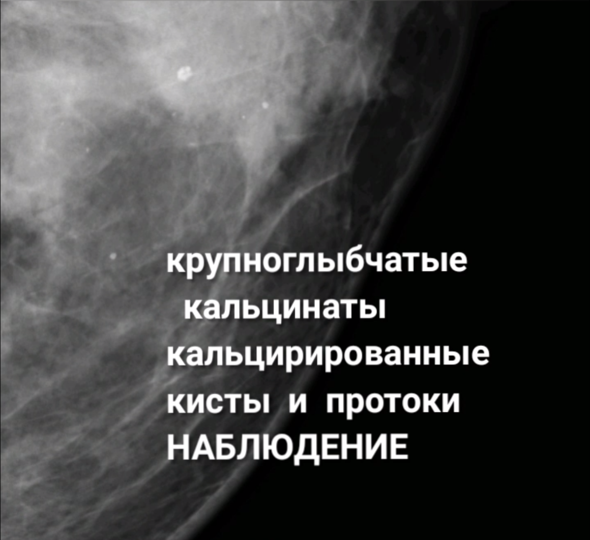 Микрокальцинаты в молочной Микрокальцинаты в молочной