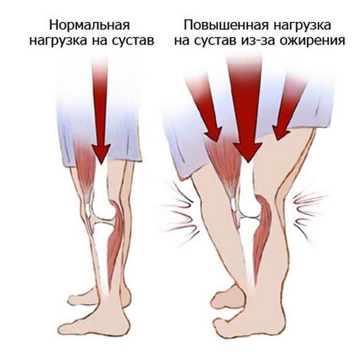 Нагрузка на суставы формируется и усиливается со всех сторон под действием избыточного веса