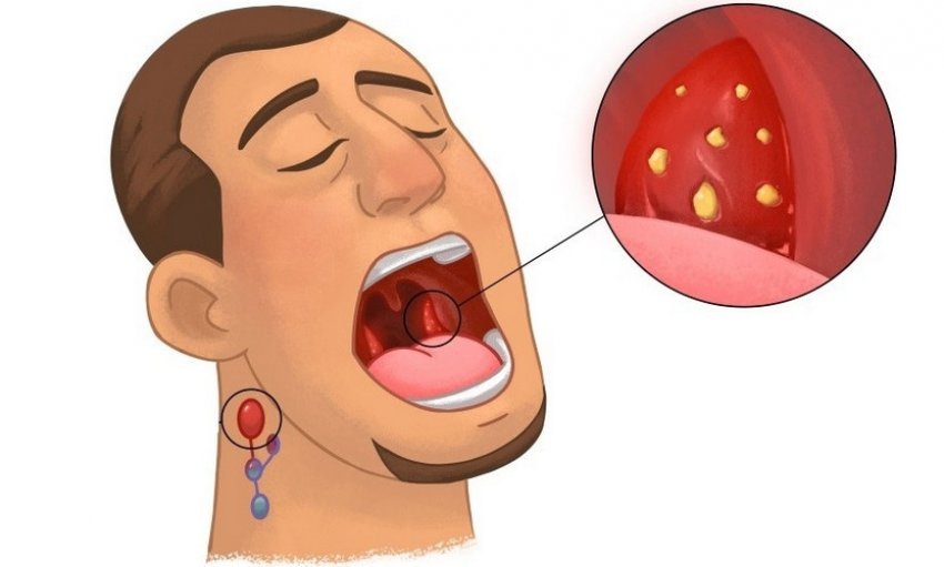 Закупоривание лакун миндален