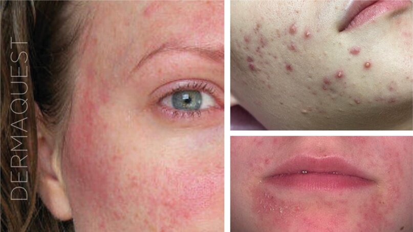 Перед началом терапии важна постановка точного диагноза