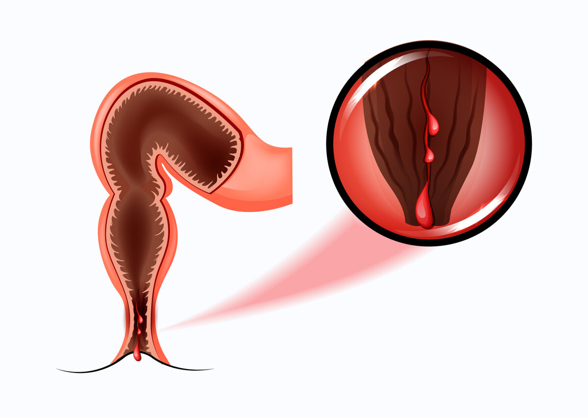Кровотечение из прямой кишки