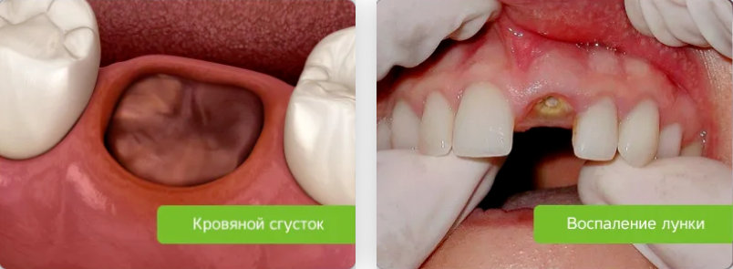 Проблемы после удаления зуба - Стоматологическая патология - Справочник MSD Профессиональная версия