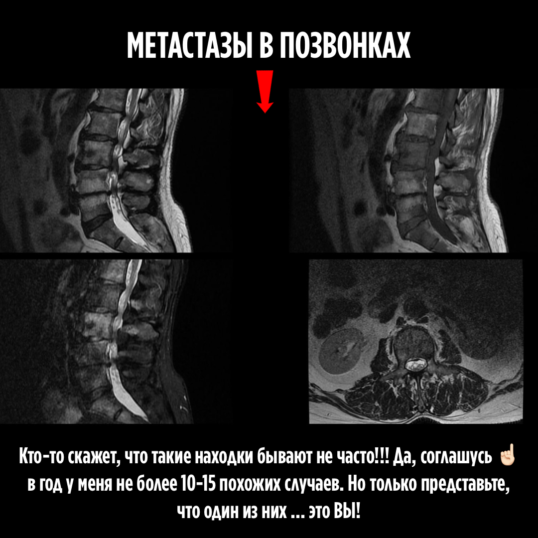 Метастазы в позвоночник прогноз жизни. Метастазы в позвоночнике на мрт. Кальцификаты в позвоночнике. Метастазы в позвоночнике симптомы и проявление.