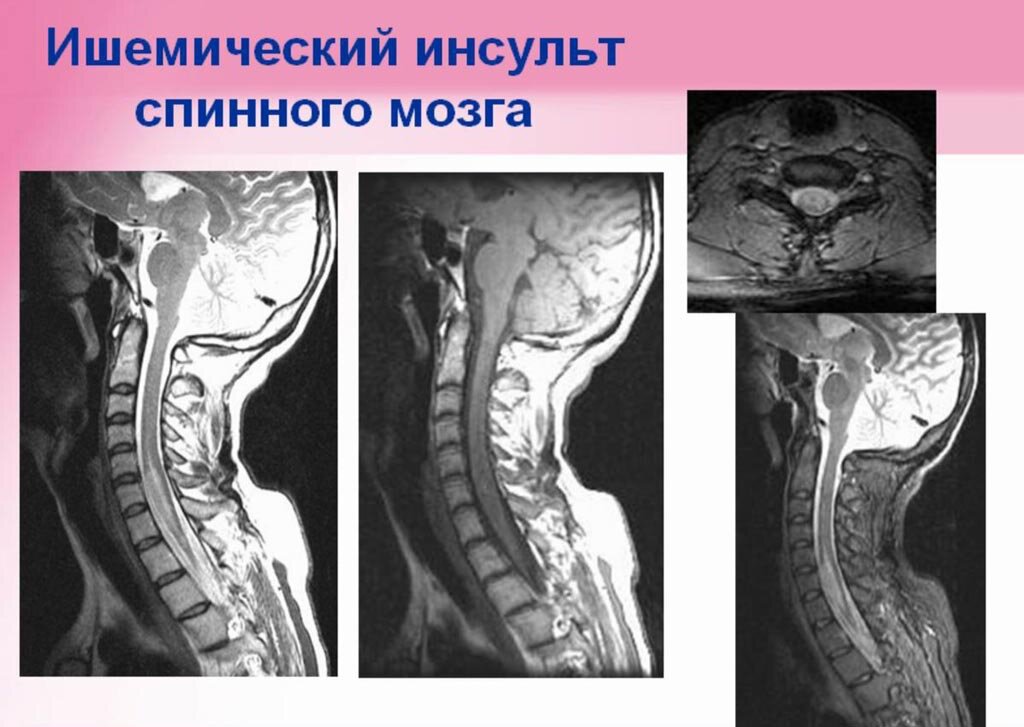 Спинальный инсульт лечение