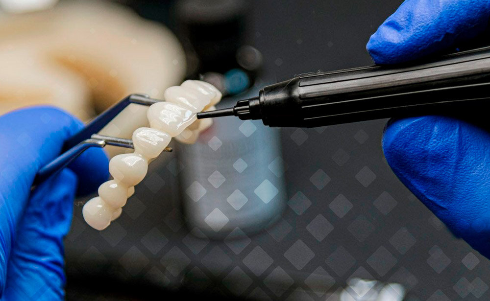 Как можно выбрать золото, если есть керамические коронки? Ведь это невероятно красиво! Никто из вашего окружения даже не догадается, что ваши зубы имеют искусственное происхождение. Фото: Smile-at-Once.ru. 