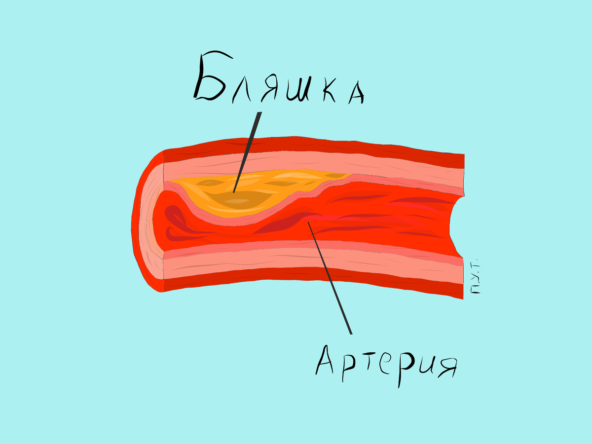 Артериолосклероз и атеросклероз. Симптомы атеросклероза кровеносных сосудов. Как понять что забиты сосуды. Основные симптомы атеросклероза. Признаком атеросклероза артерий головного мозга является *.