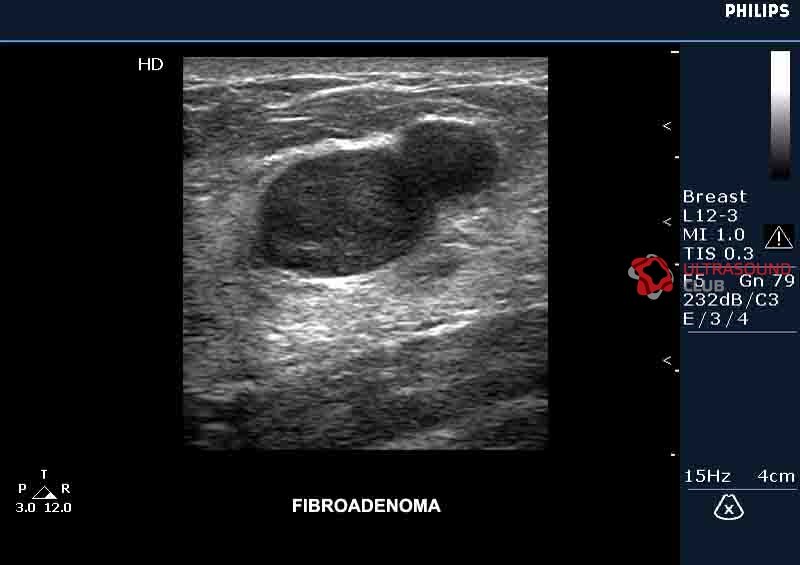 УЗИ молочной железы 